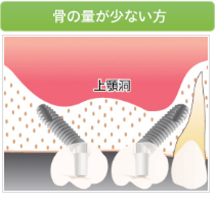 骨の量が少ない方