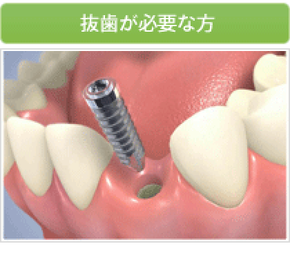 抜歯が必要な方