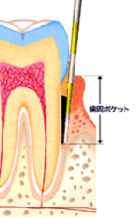 歯周ポケット