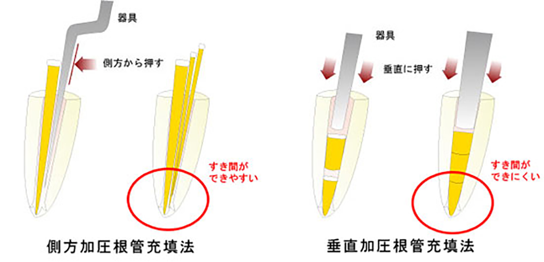 側方加圧方式